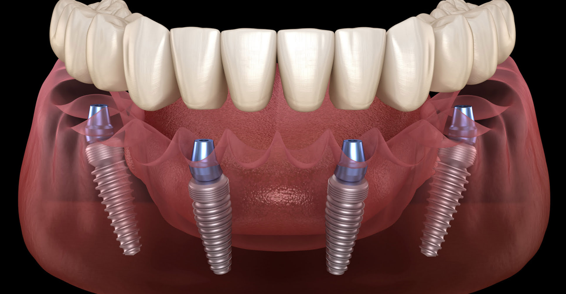 Stomatološka ordinacija dr Cvijetić Impladent - prikaz zubnog implantata s četiri implantata
