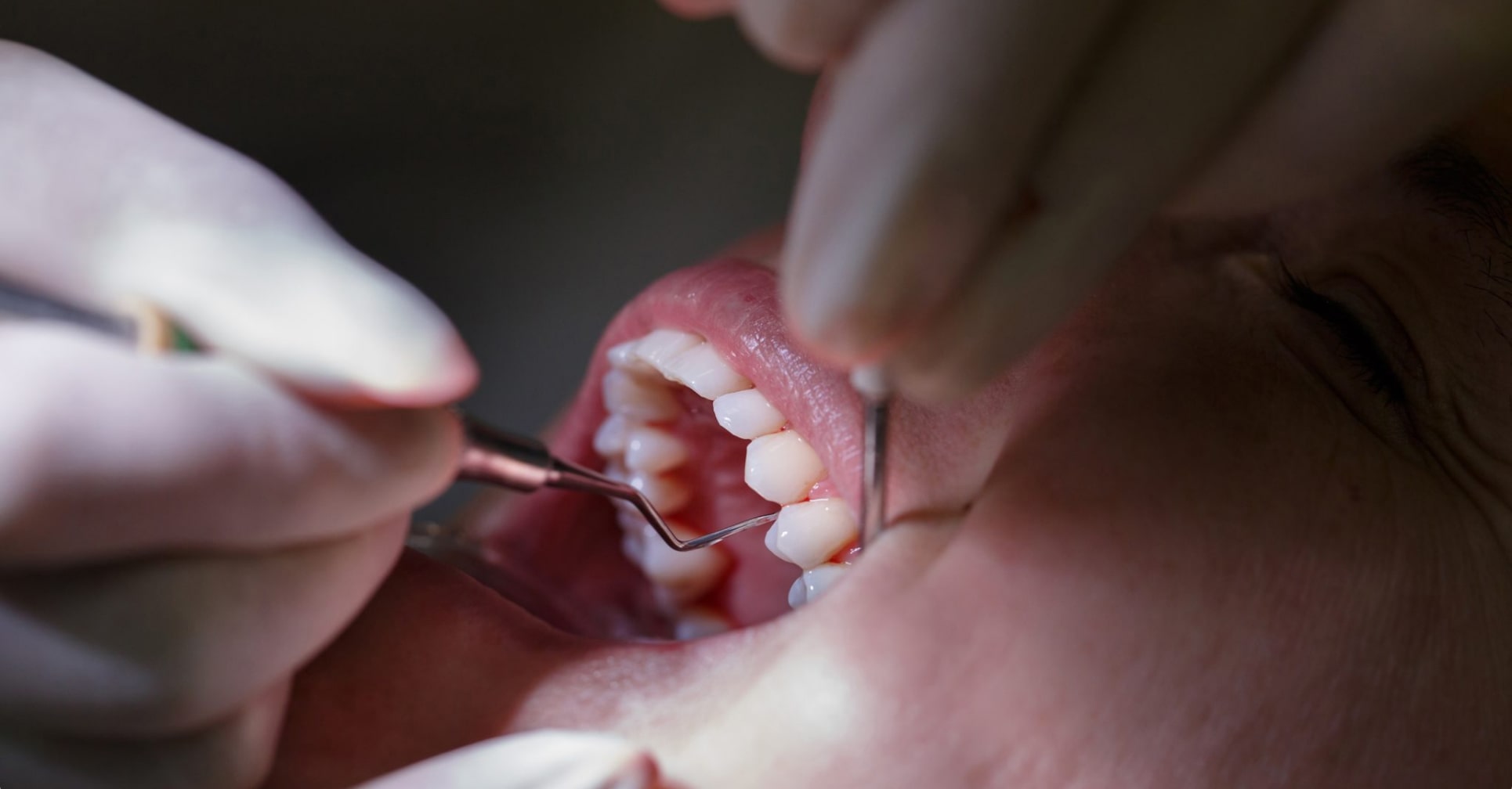 Stomatološka ordinacija dr Cvijetić Impladent - skidanje kamenca i čišćenje zuba u dentalnoj klinici dr Cvijetić
