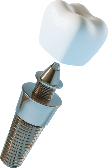 implant