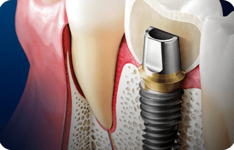 Stomatološka ordinacija dr Cvijetić Impladent - prikaz dentalne implantacijske hirurgije