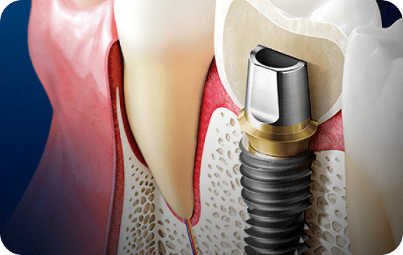 Stomatološka ordinacija dr Cvijetić Impladent - prikaz dentalne implantacijske hirurgije