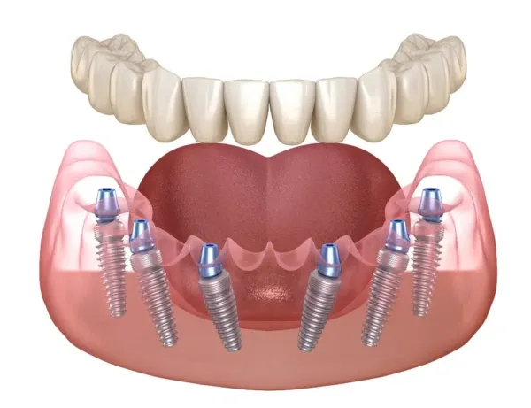 All on 6 Dental Implants - Bosnia and Herzegovina