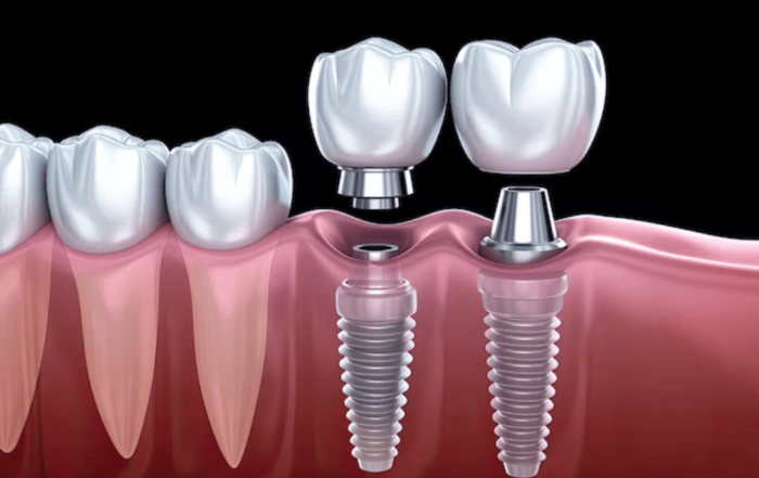 Prikaz dentalnih implantata i krunica, naglašavajući inovativne metode za poboljšanje oralnog zdravlja.